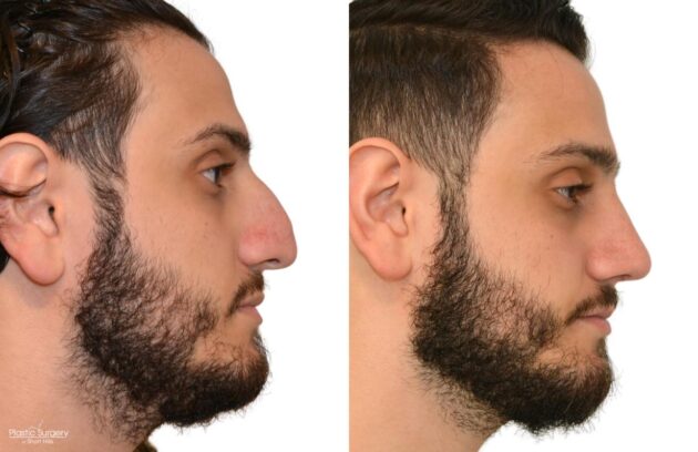 rhinoplasty